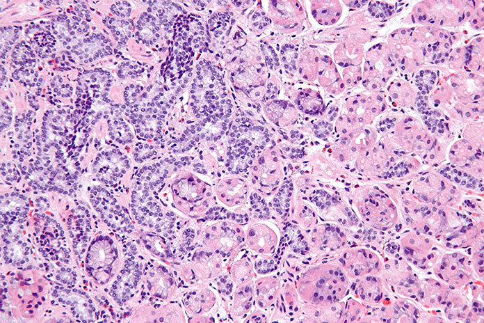 Micrograph of NET - Neuroendocrine Tumor
