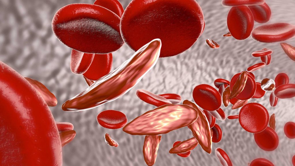 Thalassemia: Symptoms, Causes and Prevention