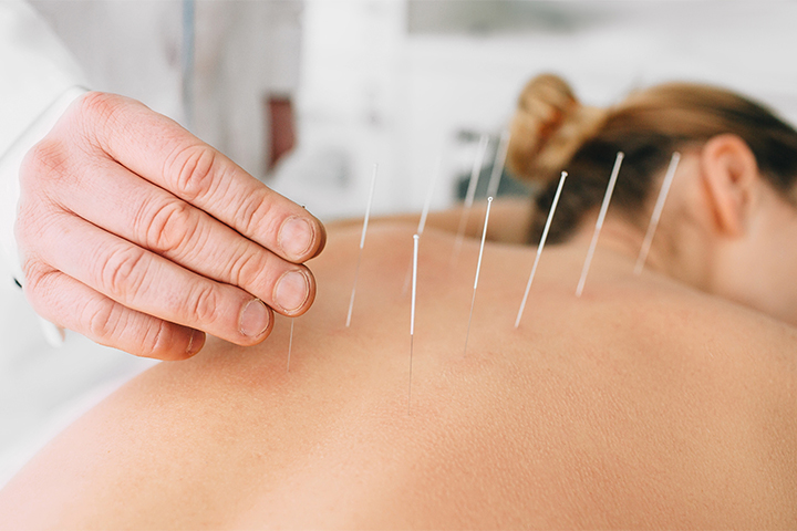 acupuncture to lose weight